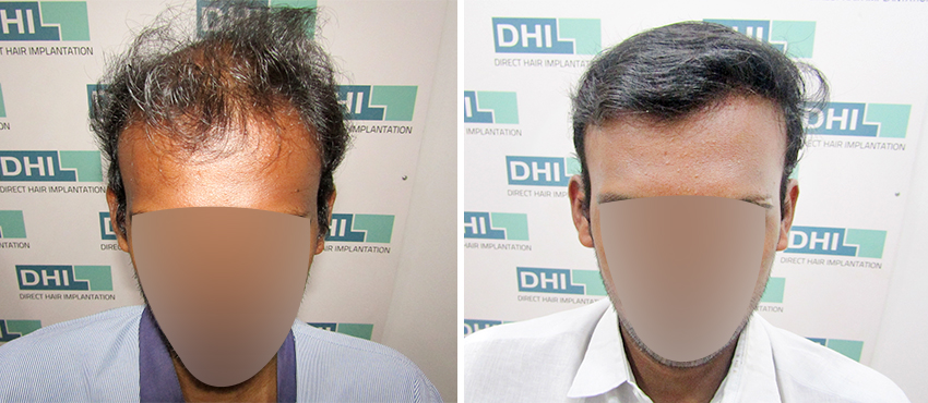 DHI before & after hair transplant results